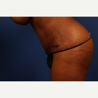 Tummy Tuck after 3743908