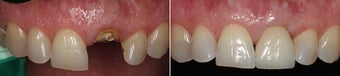 Tooth Implant before 997165