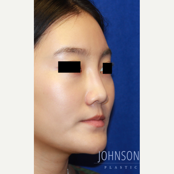 25-34 year old woman treated with Rhinoplasty before 3744745