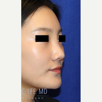 25-34 year old woman treated with Rhinoplasty after 3744745