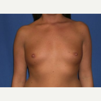 25-34 year old woman treated with Breast Augmentation before 3219963