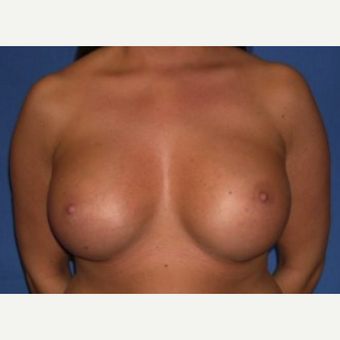 25-34 year old woman treated with Breast Augmentation after 3219963
