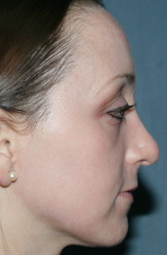 Fraxel Repair for Acne after 1064637