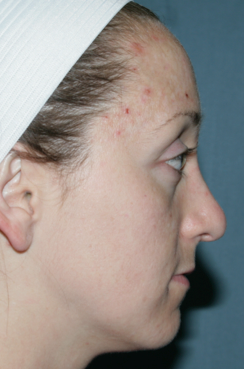 Fraxel Repair for Acne before 1064637