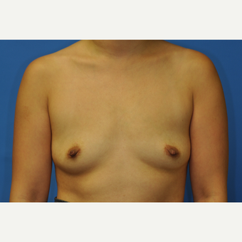 32 year old woman treated with Breast Augmentation using Ideal Implants before 3379773