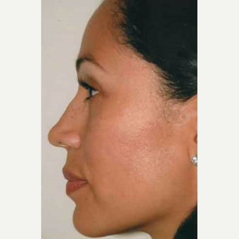 35-44 year old woman treated with Rhinoplasty after 3406197