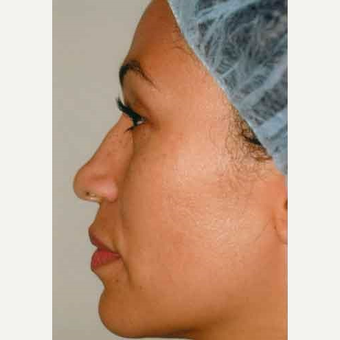 35-44 year old woman treated with Rhinoplasty before 3406197