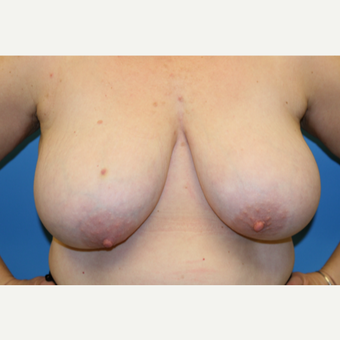 45 year old woman treated with Breast Reduction before 3582109