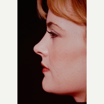 25-34 year old woman treated with Rhinoplasty before 2565172