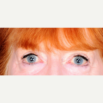 62 year old woman treated with upper eyelid blepharoplasty after 3839230