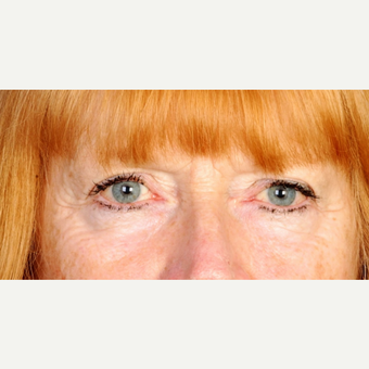 62 year old woman treated with upper eyelid blepharoplasty before 3839230
