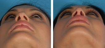 Revision Rhinoplasty before 1208284