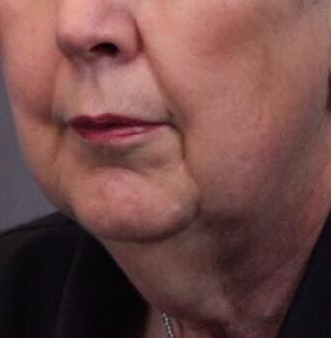 75 and up year old woman treated with Facelift before 3758424