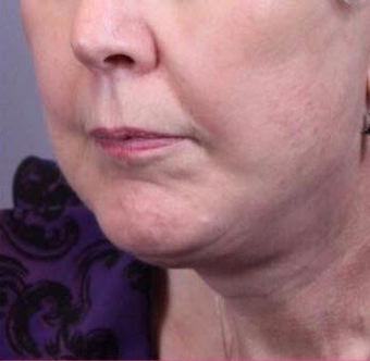 75 and up year old woman treated with Facelift after 3758424