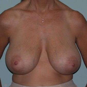 35-44 year old woman treated with Breast Reduction before 2624475