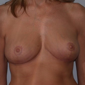 35-44 year old woman treated with Breast Reduction after 2624475