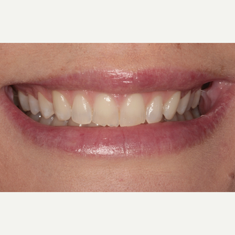 25-34 year old woman treated with Porcelain Veneers before 3281030