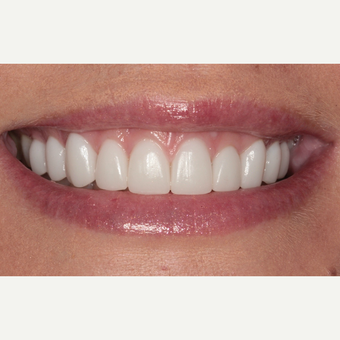25-34 year old woman treated with Porcelain Veneers after 3281030