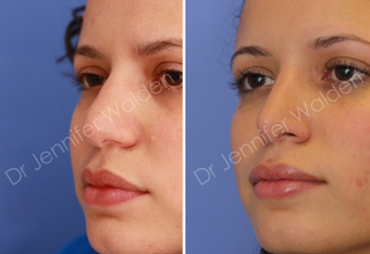 Septorhinoplasty before 1112647