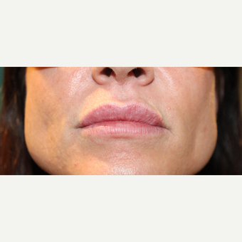 35-44 year old woman treated with Volbella after 3663932