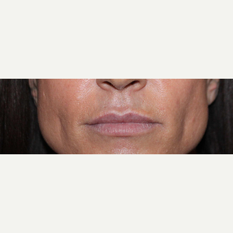 35-44 year old woman treated with Volbella before 3663932