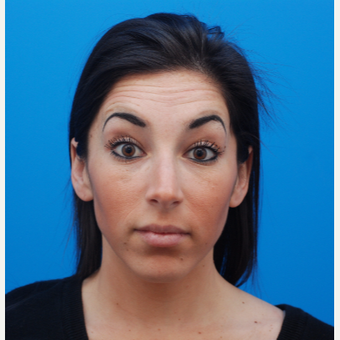 25-34 year old woman treated with Botox before 3287633