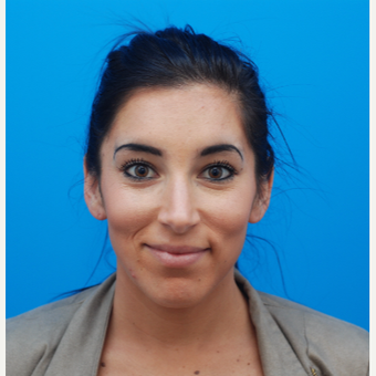 25-34 year old woman treated with Botox after 3287633