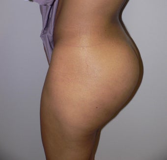 39 year old woman has Butt Augmentation 990694