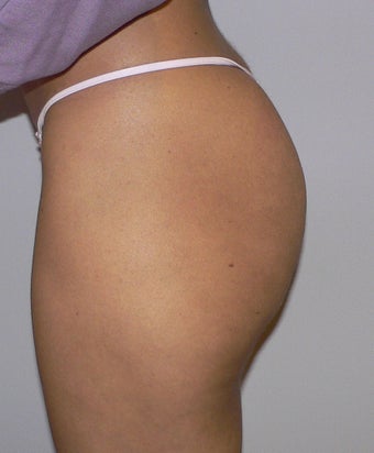 39 year old woman has Butt Augmentation 990694