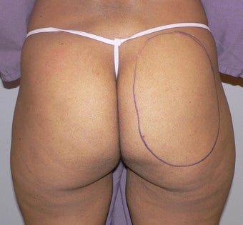 39 year old woman has Butt Augmentation before 990694