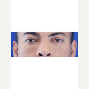 25-34 year old man treated with Fat Transfer after 3653535