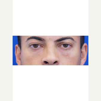 25-34 year old man treated with Fat Transfer before 3653535