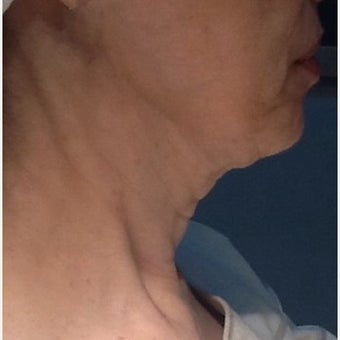 55-64 year old woman treated with Pelleve before 1599389