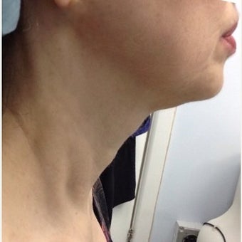 55-64 year old woman treated with Pelleve after 1599389