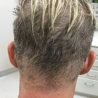 40 year old man treated with FUE Hair Transplant after 3615202
