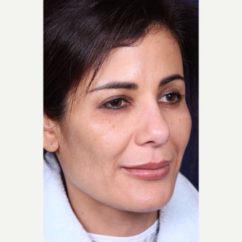 35-44 year old woman treated with Cheek Augmentation before 1974441