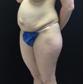 35-44 year old woman treated with Tummy Tuck before 3219223
