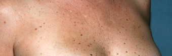 Fraxel Laser on Chest before 1064728
