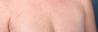 Fraxel Laser on Chest after 1064728