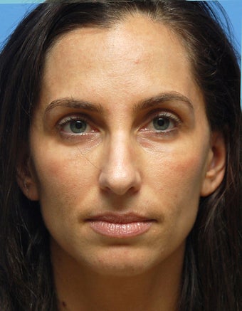 Eye Dermafillers,Cheek Dermafillers,Facial Dermafillers after 442084