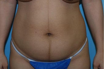 35-44 year old woman treated with Tummy Tuck before 3055907