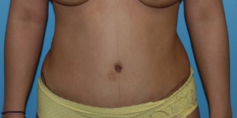 35-44 year old woman treated with Tummy Tuck after 3055907