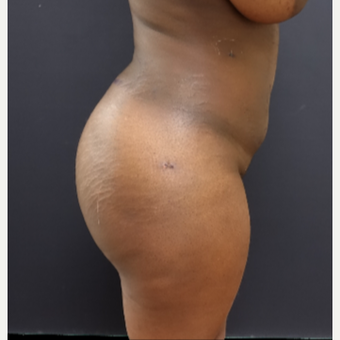 25-34 year old woman treated with Butt Lift after 3363878
