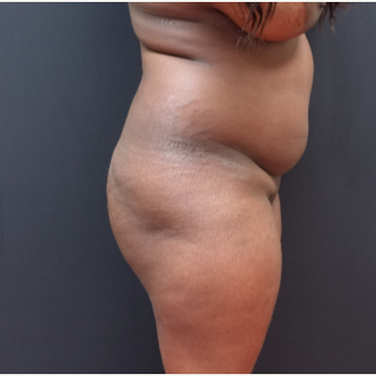 25-34 year old woman treated with Butt Lift before 3363878