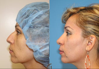 Nose job or Rhinoplasty after 252421