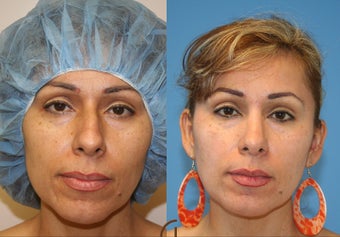 Nose job or Rhinoplasty before 252421