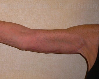 67 Year Old Woman has Brachioplasty after 1219171