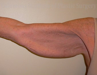 67 Year Old Woman has Brachioplasty before 1219171