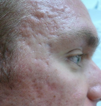 Acne Scars Treatment before 1520757