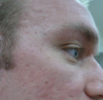 Acne Scars Treatment after 1520757